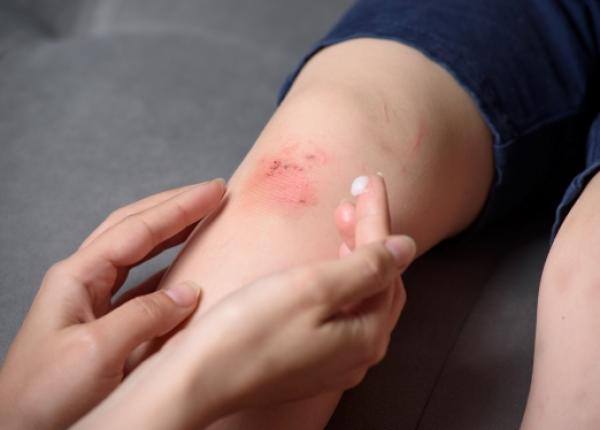 tratament pentru rani zgarieturi si julituri sfaturi si recomandari