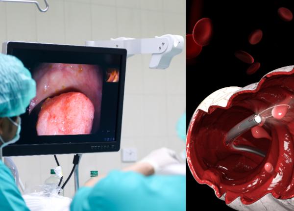 colonoscopia cand trebuie facuta 45 de ani martian sfantul screening cancer colon cancer colorectal colonoscopia cand trebuie facuta 45 de ani martian sfantul screening cancer colon cancer colorectal