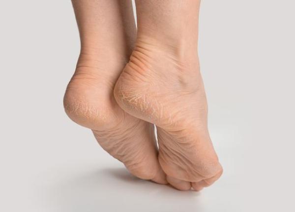 bolile din spatele calcaielor crapate