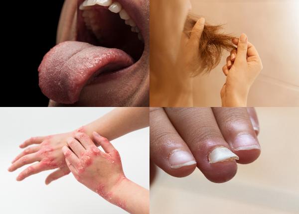 deficitul de vitamine semnele malnutritia deficitul de vitamine semnele malnutritia