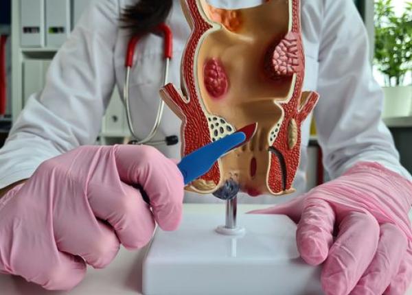 cancerul de rect cauze simptome si tratament