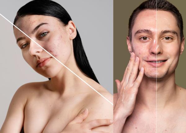 roaccutane prospect tratament acneea depresie