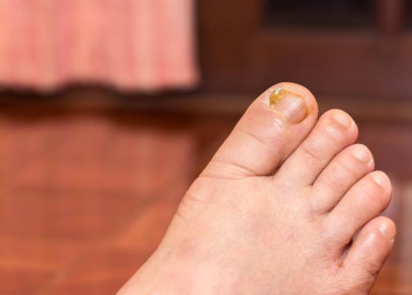 unghiile incarnate de la dureri la infectii