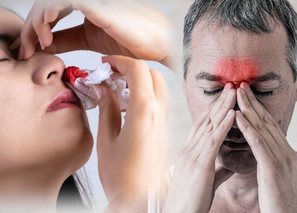 sangerare nazala ce sa faci cand iti curge sange din nas cum opresti sangerarea