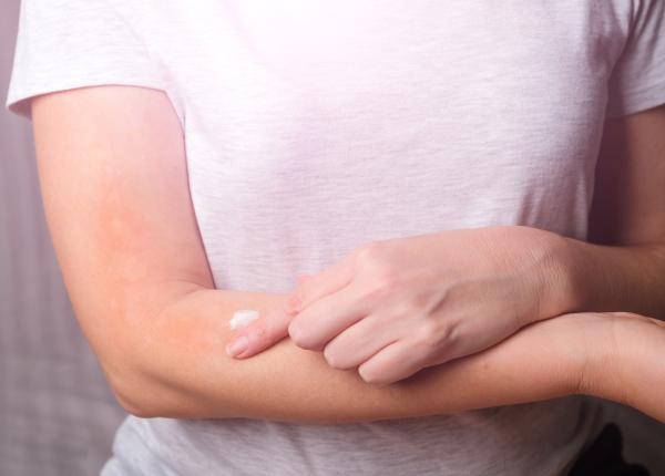 neurodermatita boala de piele cronica