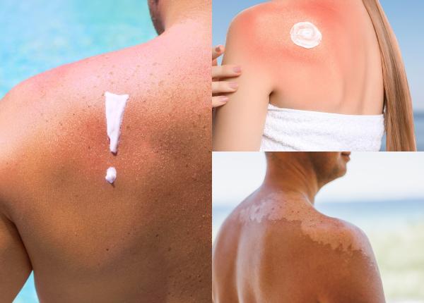 cum tratam arsurile solare cancer de piele