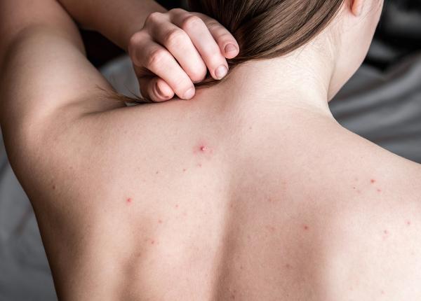 keratoza foliculara cauze simptome si tratament anghel