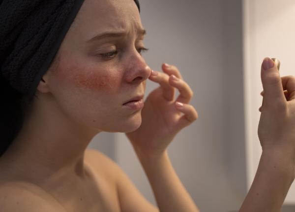 lupusul asociat cu afectarea sanatatii mintale