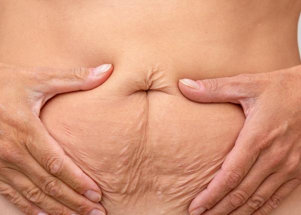 cortizolul motivul grasimii de pe burta hormonul stresului