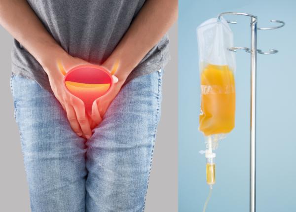 sonda urinara ce rol are cand se pune dumitrache pietrele vezica rinichi sonda urinara ce rol are cand se pune dumitrache pietrele vezica rinichi