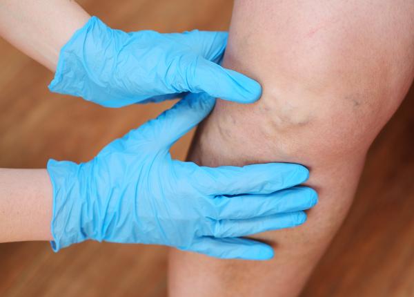 tromboflebita cauze simptome si tratament