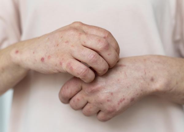 fitofotodermatita boala gradinarilor fitofotodermatita boala gradinarilor
