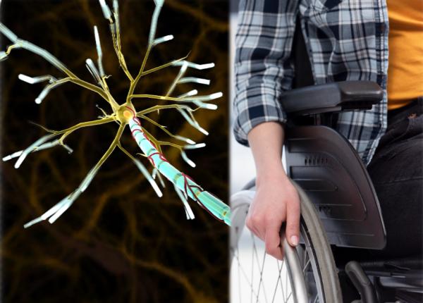 scleroza multipla scleroza in placi cauze simptome tratament mutatia genetica