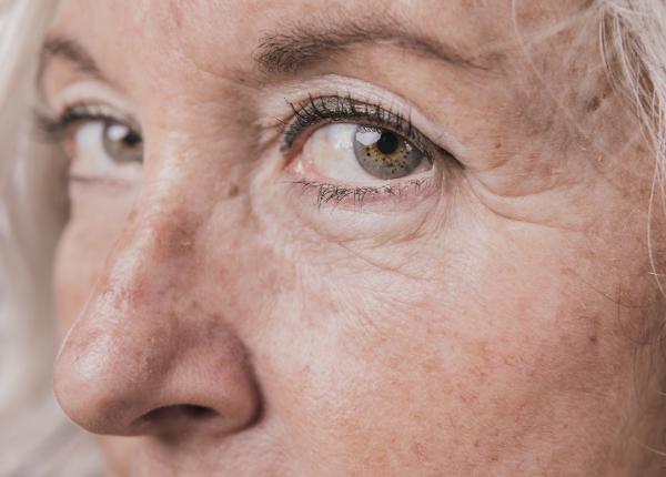 petele de varsta simptome cauze tratament