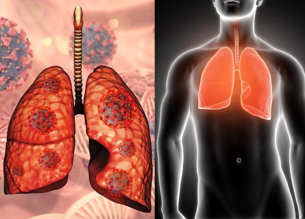 cancer pulmonar test primul semn natalia motas parsiv cancer pulmonar test primul semn natalia motas parsiv