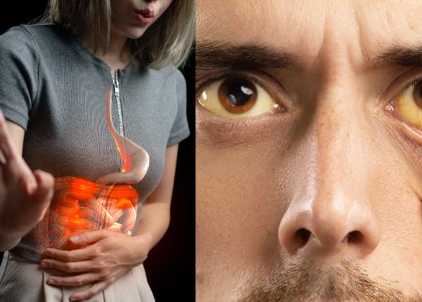 vezica biliara semnul de pe limba si din ochi probleme cu bila