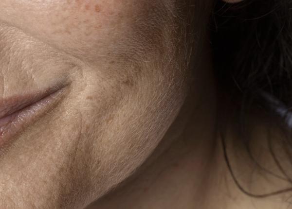 pistruii semn al unui cancer in stadiul 4 melanom