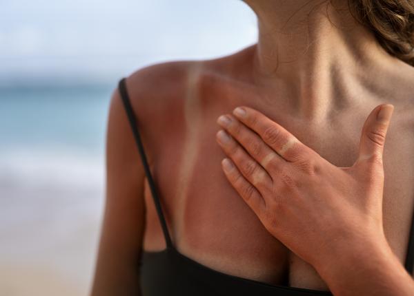 cum tratezi arsurile solare