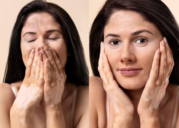 vitiligo tipuri si simptome cauza care declanseaza vitiligo tratament