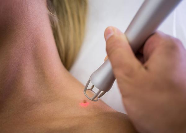 condiloamele canceroase condilomatoza trateaza cioflan