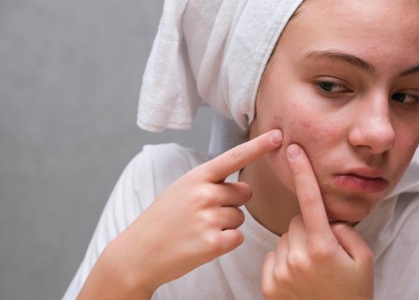 9 greseli pe care le faci cand ai acnee