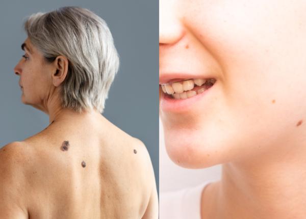 alunitele alunita sanatoasa alunita periculoasa melanom mihaela leventer