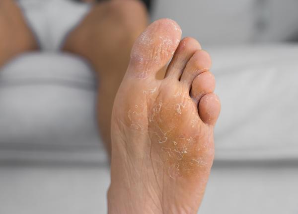 ciuperca piciorului cauze si simptome