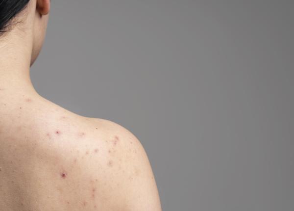 cosurile de pe corp cauze tratamente preventie