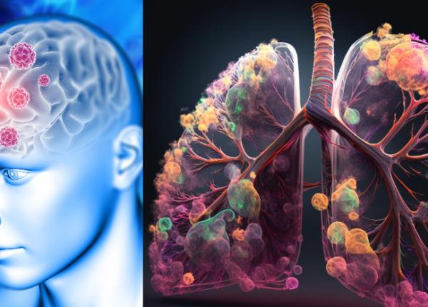 cancerul pulmonar agresiv cancer creier oase inima metastaze