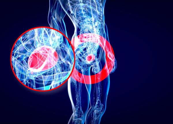 adenomul de prostata cea mai frecventa tumoare adenomul de prostata cea mai frecventa tumoare