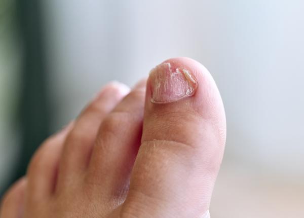 ciuperca unghiei dincolo de estetica ciuperca unghiei dincolo de estetica