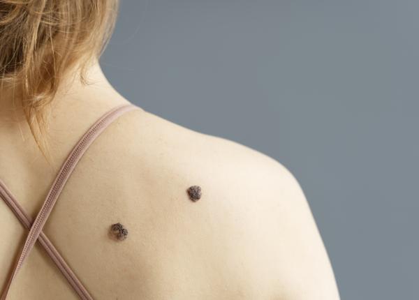 cum se formeaza alunitele cum se formeaza alunitele