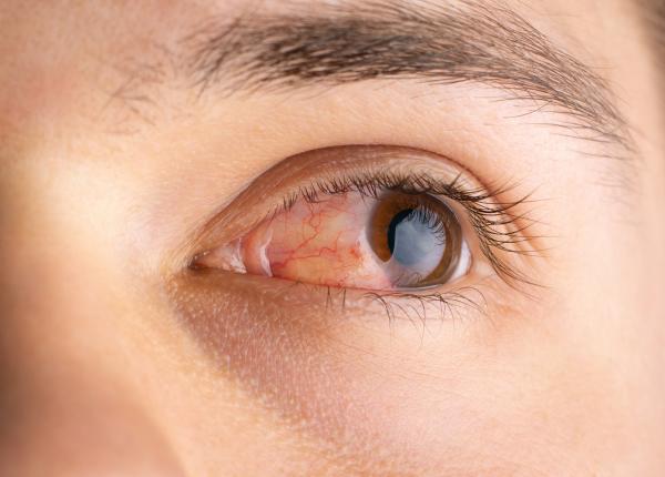 icterul cauze simpome tratament