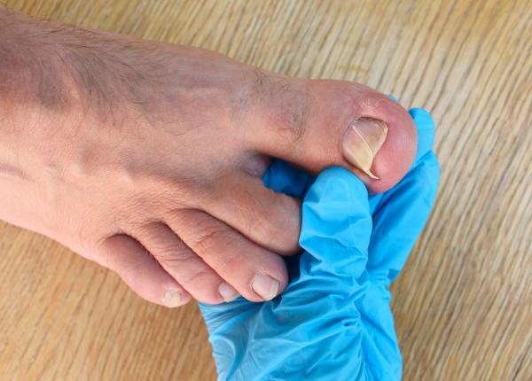 unghiile ingrosate de la picioare semn al unor boli mortale