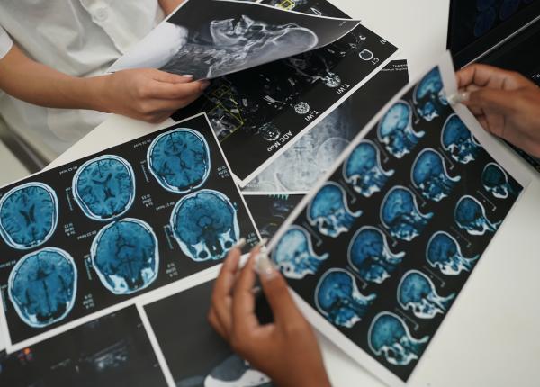 tumoare cerebrala agresiva confundata cu apendicita