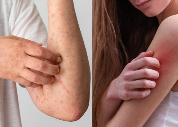 urticarie cauze simptome tratament bube rosii mancarimi