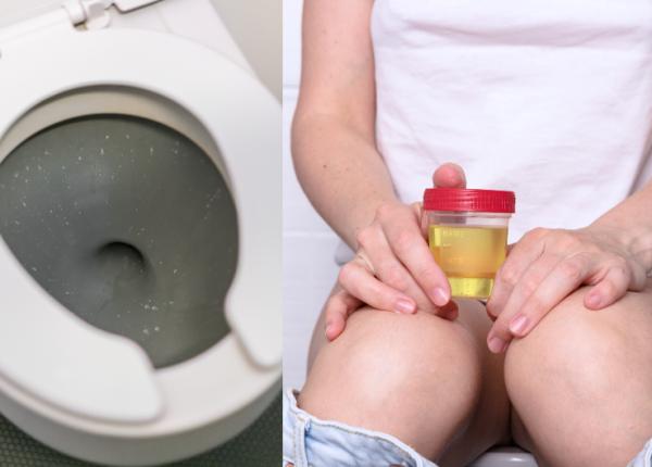 cancer urologic primul simptom sange urina hematurie cancer urologic primul simptom sange urina hematurie