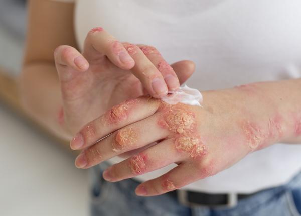 psoriazisul boala subdiagnosticata din cauza rusinii psoriazisul boala subdiagnosticata din cauza rusinii