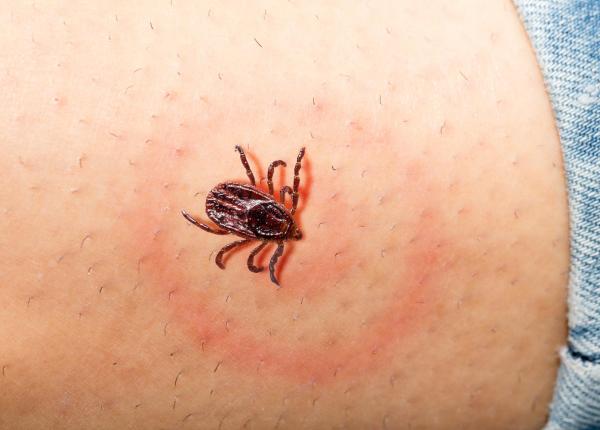 boala transmisa de capuse care sunt simptomele bolii lyme