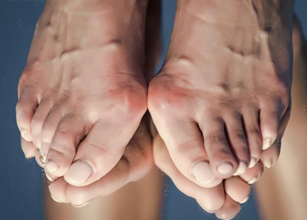 monturi hallux valgus semne tratament codrin huszar degetul mare monturi hallux valgus semne tratament codrin huszar degetul mare