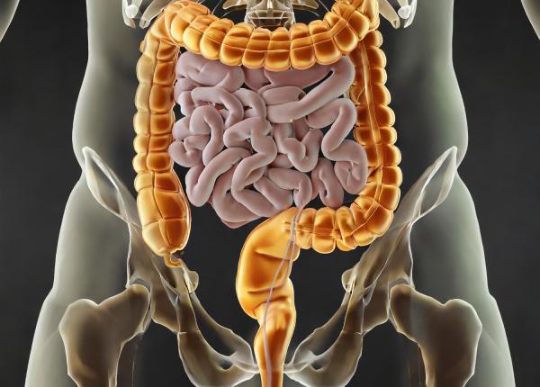 cancerul colorectal ghid de preventie copac roccas