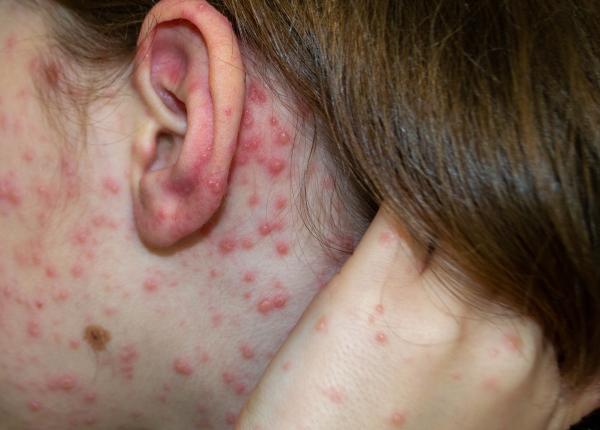 rujeola cauze simptome tratament ce este semnul koplik tudor ciuhodaru avertizeaza extrem de contagioasa