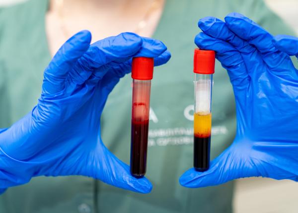 transaminazele crescute roxana sirli analiza fibroza ciroza