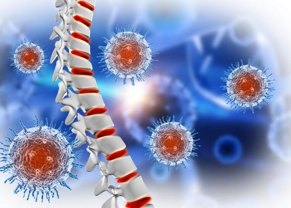 tumoare vertebrala semn dr bentia fizioterapie metastaze