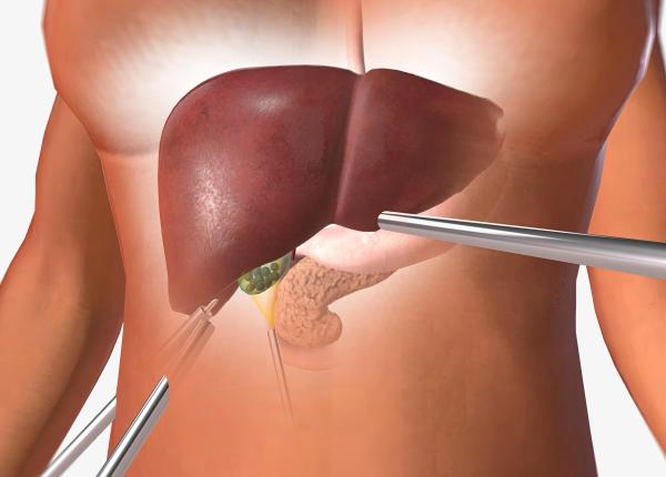 steagul rosu al cirozei hepatice