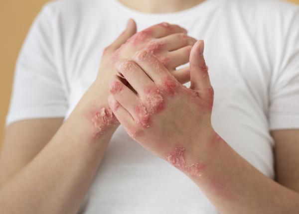 dermatita seboreica cauze simptome tratament cat de grava poate fi aceasta afectiune dermatita seboreica cauze simptome tratament cat de grava poate fi aceasta afectiune