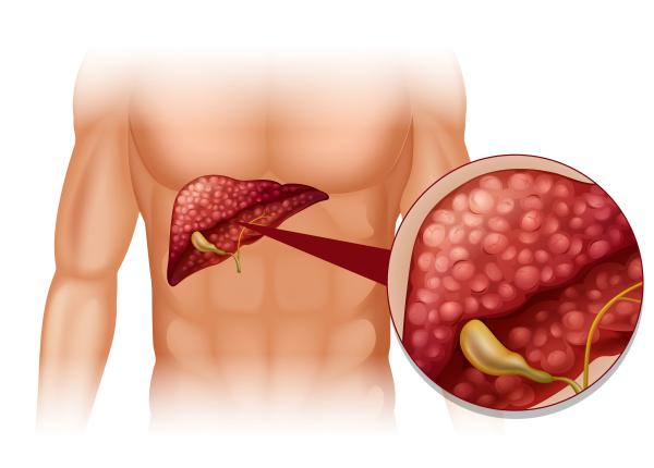 primul semn banal al tumorii hepatice dr dragos romanescu ciroza hepatica primul semn banal al tumorii hepatice dr dragos romanescu ciroza hepatica