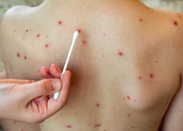 jumatate din tarile lumii vor avea un risc crescut de rujeola pana la finalul anului