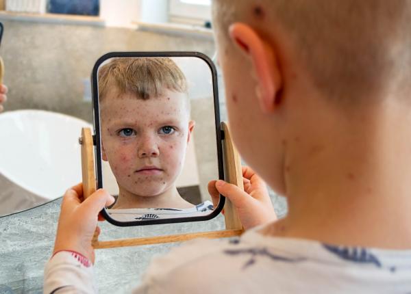 primele semne ale pojarului vaccinarea ramane cea mai eficienta metoda de prevenire