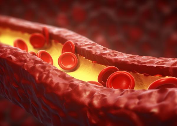 semnul care iti arata ca ai colesterolul marit